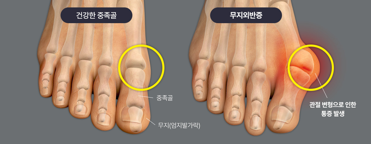 건강한 중족골 / 무지외반증 비교