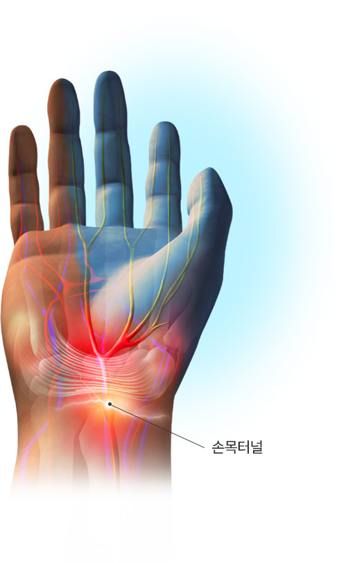 손목터널