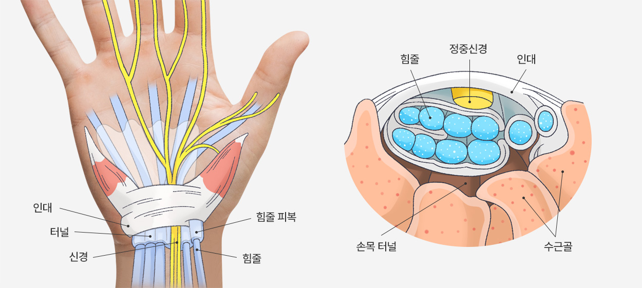 인대, 터널, 신경, 힘줄 피복, 힘줄 / 힘줄, 정중신경, 인대, 수근골, 손목 터널
