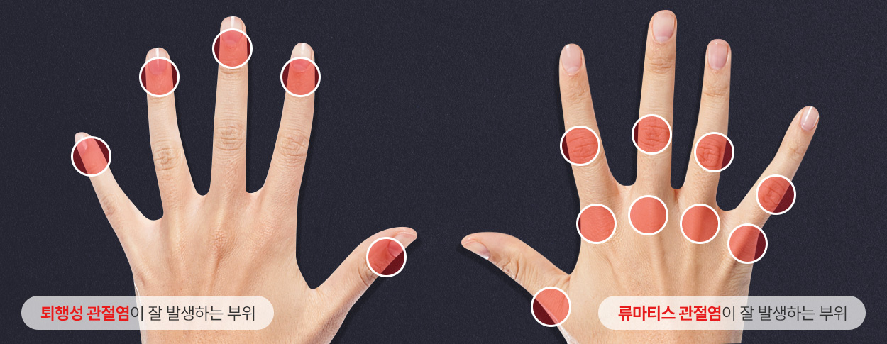 퇴행성 관절염이 잘 발생하는 부위 / 류마티스 관절염이 잘 발생하는 부위