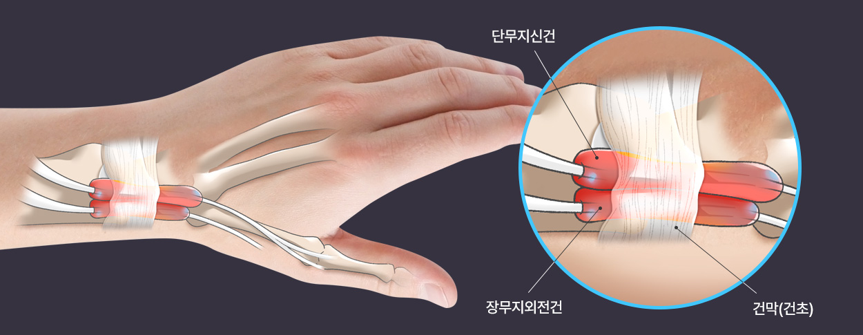 단무지신건 / 장무지외전건 / 건막(건초)
