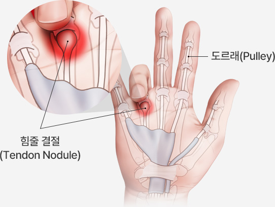 힘줄 결절(Tendon Nodule) / 도르래(Pulley)