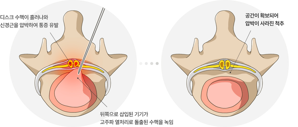 디스크 수핵이 흘러나와 신경근을 압박하여 통증 유발 | 뒤쪽으로 삽입된 기기가 고주파 열처리로 돌출된 수핵을 녹임 > 공간이 확보되어 압박이 사라진 척추